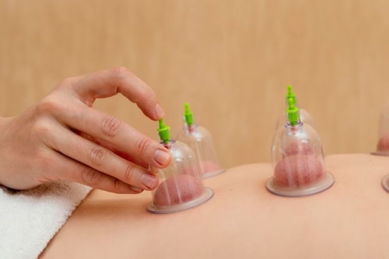 دورة الحجامة وسحب الدم الفاسد